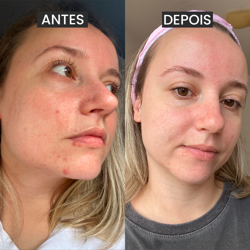 Kit SOS Acne Adulta Edição Black Friday