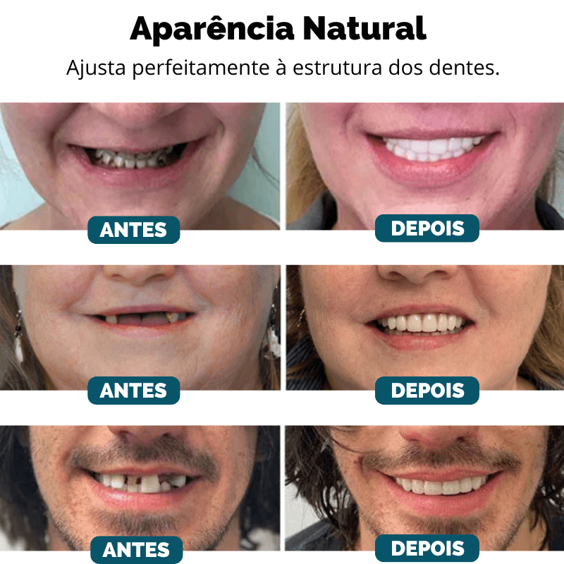 Facetas Dentárias Universal Smile